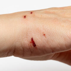 Understanding Snake Bite: Symptoms, First Aid, and Prevention